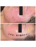 【ニキビ・毛穴集中ケア】剥離なし！REVIハーブピーリング￥11,000→￥8,800