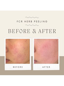 サロンアン(Salon an)/肌質改善にFCRハーブピーリング