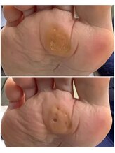 リゼラアンドコー 柏原店/魚の目ケア！