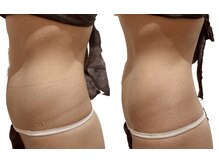 痩せラボ/浮腫改善【痩身】