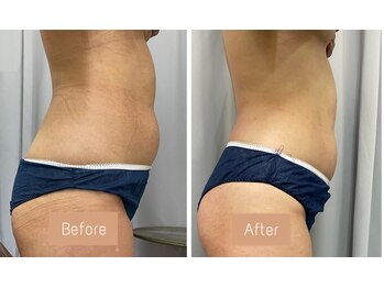 FJ/お腹まわりの頑固な脂肪も◎