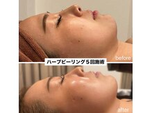 スピード美人 横浜店の雰囲気（30分の時短メニューハーブピーリング。毛穴消滅でつるつる卵肌へ）