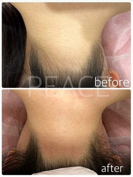 ピース(PEACE)/うなじワックス脱毛