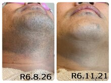 フィズ 五日市彩が丘店(FIS)/☆美肌脱毛☆髭脱毛