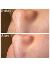 マドモアゼル 麻布十番/毛穴洗浄