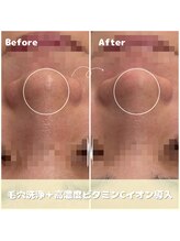 クレア(Clair)/毛穴洗浄