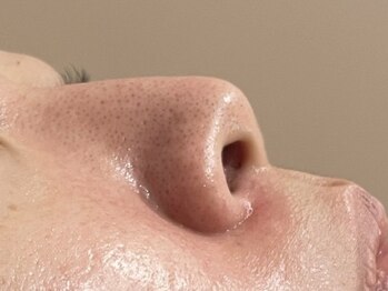 アンドユー ヨコハマ(&U Yokohama)/クリスティーナ施術前