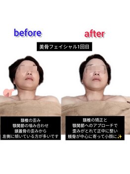 ブランシュール(blancheur)の写真/お顔のたるみが気になる方へ必見!小顔効果◎美骨フェイシャルをご体感下さい♪