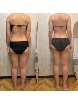 ラヴィニティ 自由が丘店(Lavinity)/【40代】ビフォー、アフター