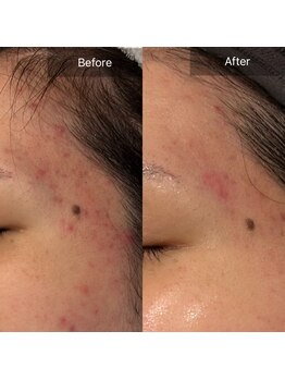 マインエム(mine.m)/トロイアルケハーブピーリング