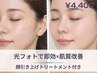 【4,400円】シミ気になる方必見/最新IPL光フォトでしっかりケア