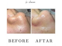 ルシェリア(Le cherien)/ハイドラフェイシャル