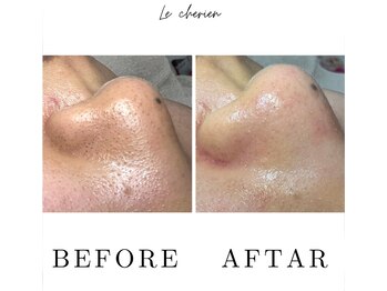 ルシェリア(Le cherien)/ハイドラフェイシャル