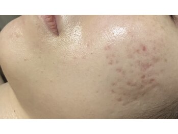 ビューティーサロン アンド ユー シブヤ(Beauty Salon&U Shibuya)/リベルハーブピーリング1回後