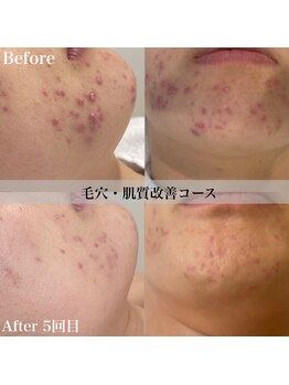 アール アンド ビューティーサロン(Ｒ＆ BeautySalon)/脱マスク！！