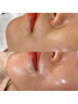 チャム(chum)/7月スタートフェイシャルWax