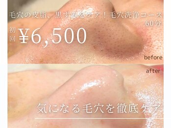 アルテ 名古屋栄店(arte)/毛穴の皮脂/黒ずみをケア！