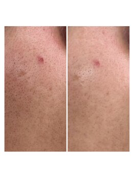 サロナプア(Salona Pua)/頬1回の施術