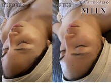 ミイン(miin)/ララピール＋ハイパーナイフ