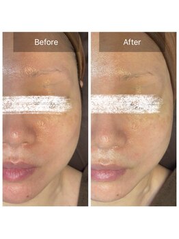 ラビ(RABBI)/50代女性小顔矯正