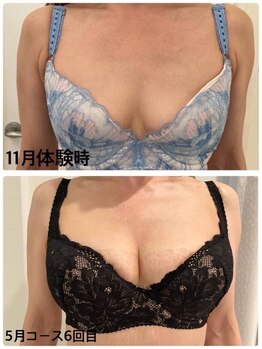 美人バスト 町田店/バストアップ◇症例◇