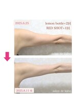 サロン ド 花歩 松山本店/痩せにくい二の腕もこの通り！