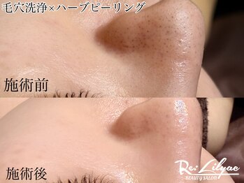 リリアック(Re:Lilyac)/Re:ilyac#ハーブピーリング