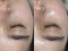 ビーマジック(Be Magic)/毛穴/毛穴洗浄/ピーリング