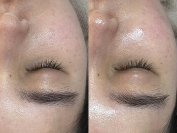 ビーマジック(Be Magic)/毛穴/毛穴洗浄/ピーリング