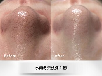 クリオ(Crio)/水素毛穴洗浄１回