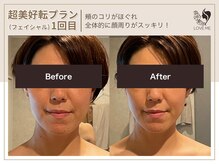 ラブミー 渋谷本店(LoveMe)/小顔・たるみ・ほうれい線・毛穴