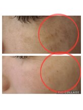 ラセラ(RASERA)/フォト美顔フェイシャル