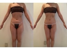 ビューティーマックス(Beauty Max)/痩身　before→after 3ヶ月後