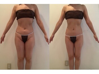 ビューティーマックス(Beauty Max)/痩身　before→after 3ヶ月後