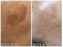 フォーチューン/シミケアプレミアム月2回