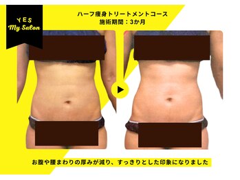 イエス マイサロン(yes My Salon)/ハーフ痩身トリートメント症例