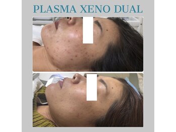 ビーダブリュー(BW...)/☆プラズマゼノデュアル施術例☆