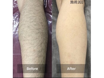 アンド 四條畷店(AND)/メンズ人気脱毛