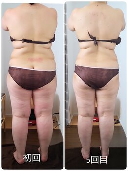 エムブルーム(m-bloom)/施術5回目ビフォーアフター♪