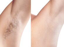 ミミ(Mimi)/WAXor痛み少ないマシン脱毛で。