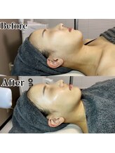 カルナ(CARNA)/VVSダイヤモンドピール使用前後