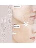【フェイシャル人気No.1★】肌質改善（剥離なし）ハーブピーリング¥5500☆