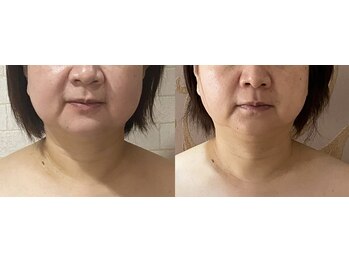 サロンドミジュ(Salon de 美jyu)/二重アゴ解消!