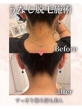 フィズ 海老名店(FIS)/うなじ脱毛