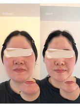 サンク(cinq)/シャープな輪郭形成