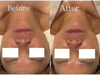 アイラブワン 大和 南林間店(eye love one)/ララピール【毛穴/小顔/リンパ】