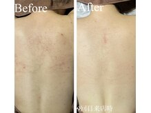 エミルカ 新宿(EMILUCA)/背中のブツブツにオススメ