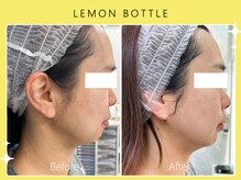 ハノハノ 八代店(HANO HANO)/小顔コルギ×レモンボトル☆