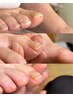 【巻き爪でお悩みの方】巻き爪ケア初回親指 1本11,000円→6,000円
