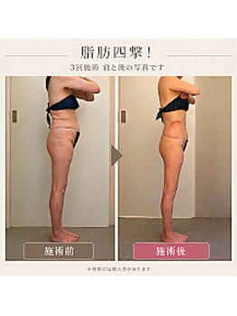 ボーテヌール(Beaute Nheur)/脂肪四撃！